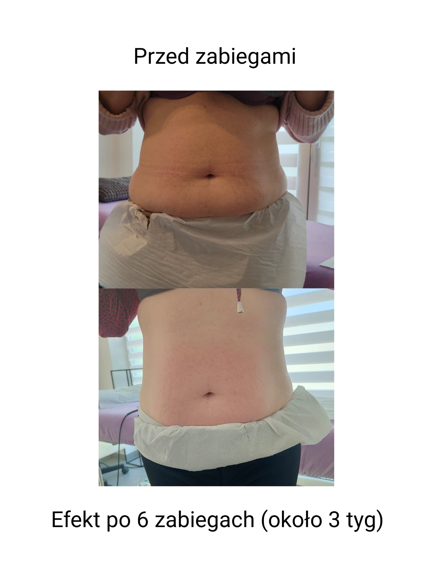 Efekt po 6 zabiegach Indiba na brzuch – widok z przodu