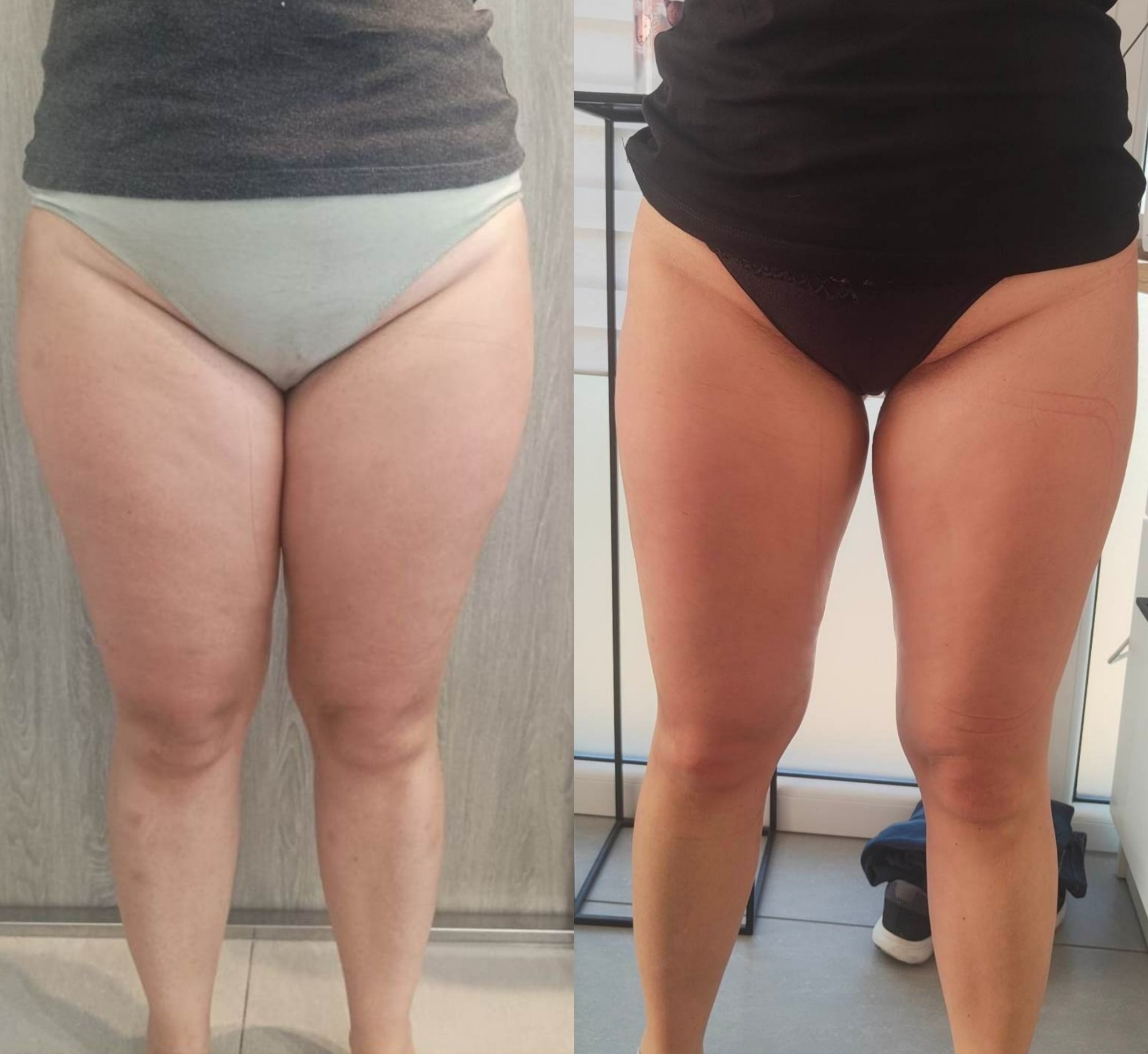 Efekt po zabiegach Indiba na uda – przed i po