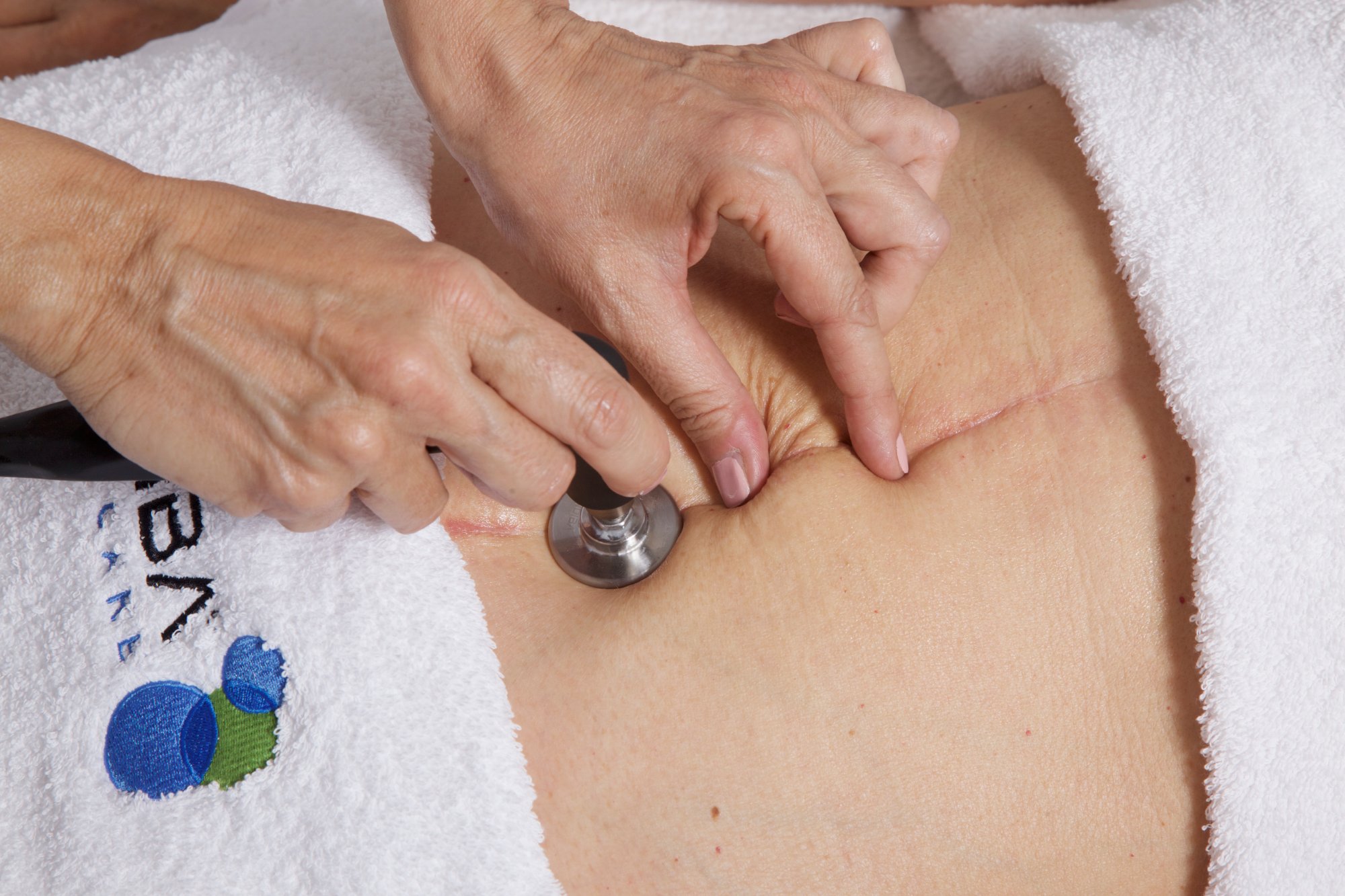 Indiba na brzuch – praca w okolicach blizny